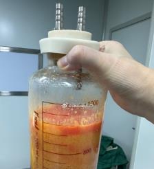 齐齐哈尔水动力吸脂手术要做多久？